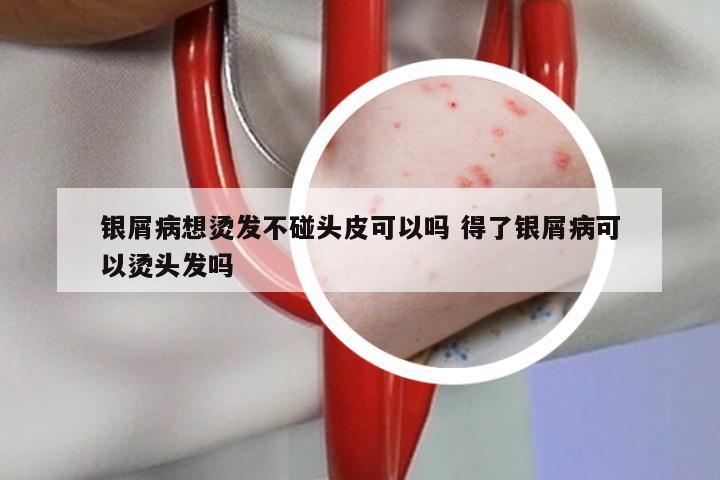 银屑病想烫发不碰头皮可以吗 得了银屑病可以烫头发吗