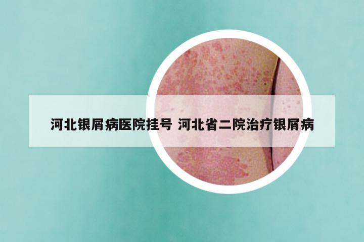河北银屑病医院挂号 河北省二院治疗银屑病