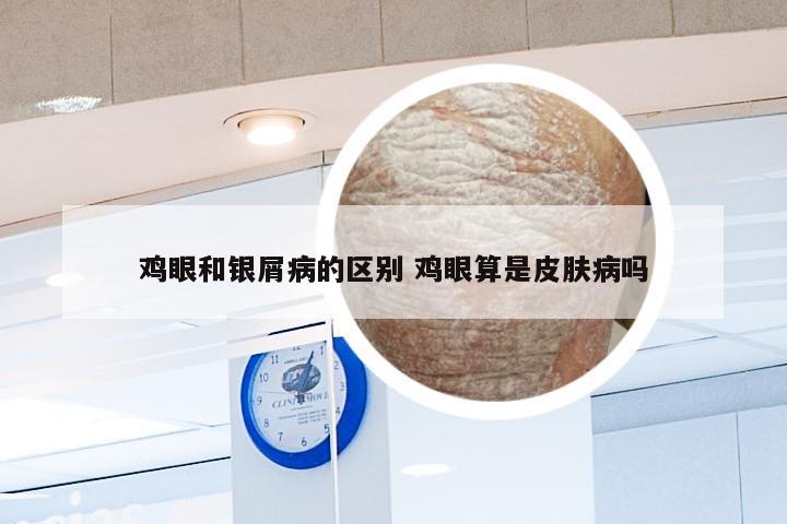 鸡眼和银屑病的区别 鸡眼算是皮肤病吗