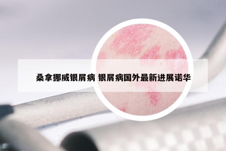 桑拿挪威银屑病 银屑病国外最新进展诺华