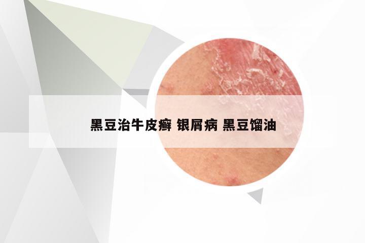 黑豆治牛皮癣 银屑病 黑豆馏油