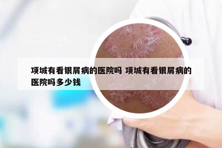 项城有看银屑病的医院吗 项城有看银屑病的医院吗多少钱