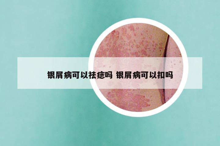 银屑病可以祛痣吗 银屑病可以扣吗