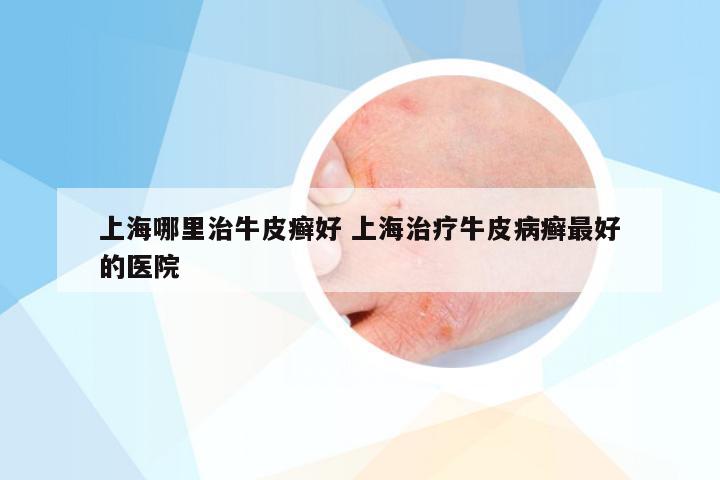 上海哪里治牛皮癣好 上海治疗牛皮病癣最好的医院