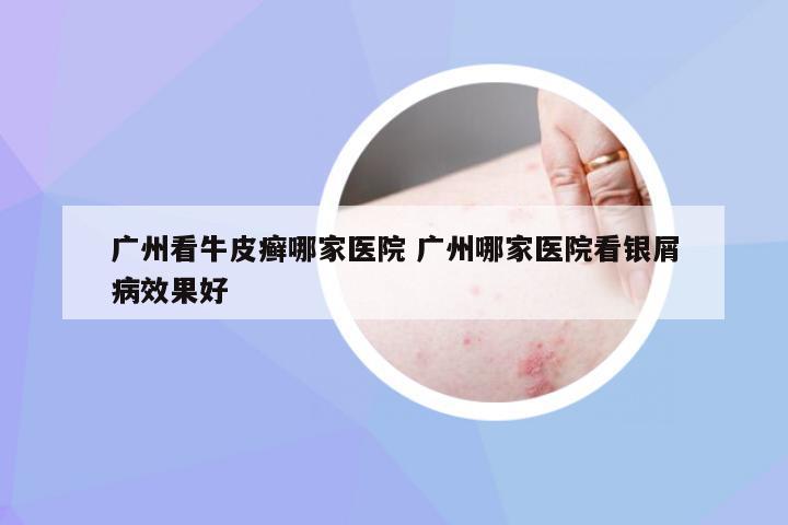 广州看牛皮癣哪家医院 广州哪家医院看银屑病效果好