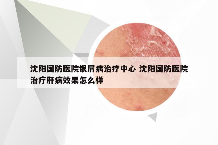 沈阳国防医院银屑病治疗中心 沈阳国防医院治疗肝病效果怎么样