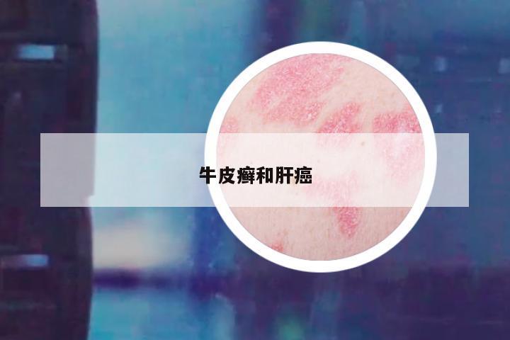 牛皮癣和肝癌