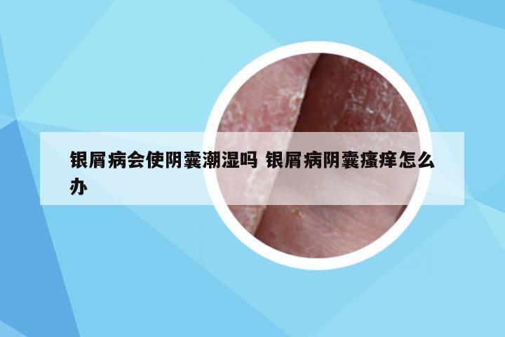 银屑病会使阴囊潮湿吗 银屑病阴囊瘙痒怎么办