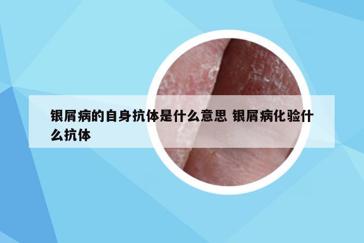 银屑病的自身抗体是什么意思 银屑病化验什么抗体