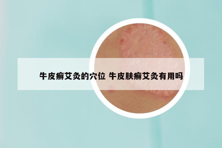 牛皮癣艾灸的穴位 牛皮肤癣艾灸有用吗