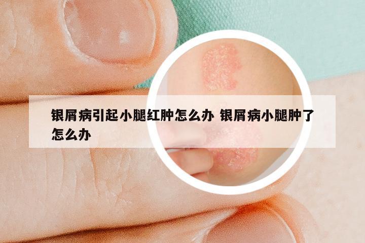 银屑病引起小腿红肿怎么办 银屑病小腿肿了怎么办