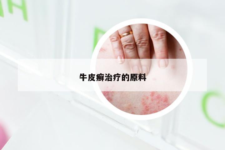 牛皮癣治疗的原料