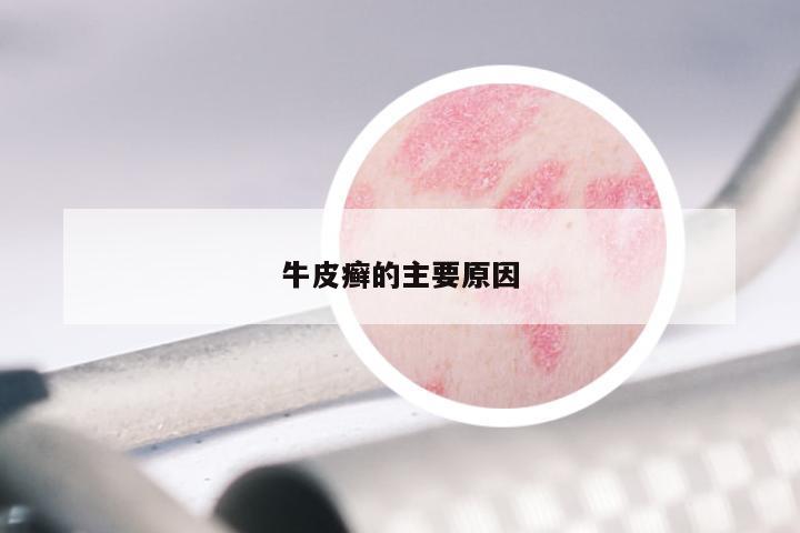 牛皮癣的主要原因