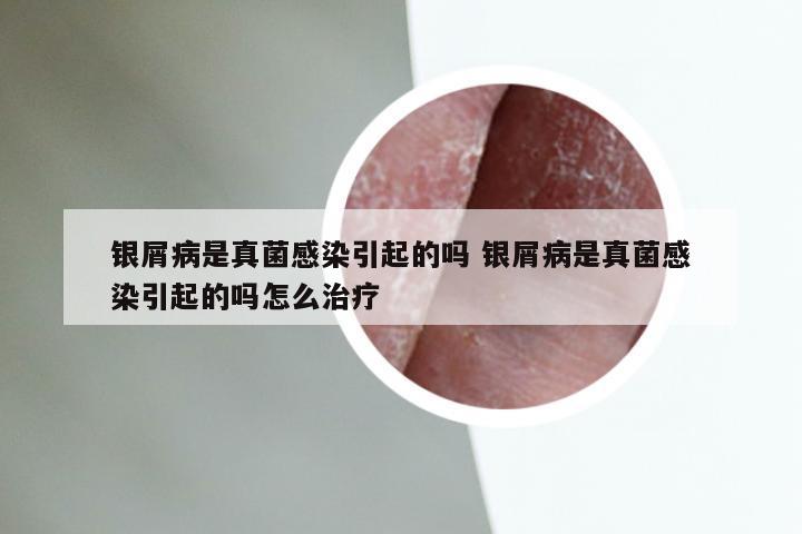 银屑病是真菌感染引起的吗 银屑病是真菌感染引起的吗怎么治疗