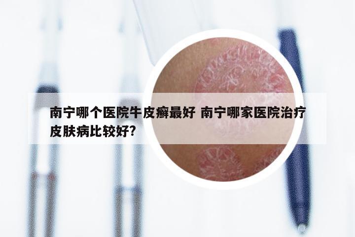 南宁哪个医院牛皮癣最好 南宁哪家医院治疗皮肤病比较好?
