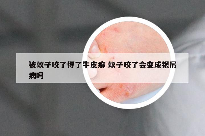 被蚊子咬了得了牛皮癣 蚊子咬了会变成银屑病吗