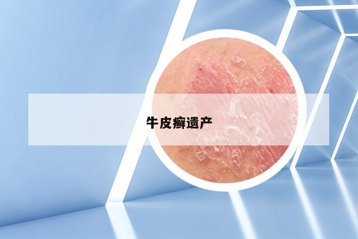 牛皮癣遗产