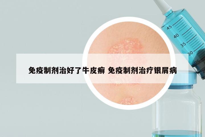 免疫制剂治好了牛皮癣 免疫制剂治疗银屑病