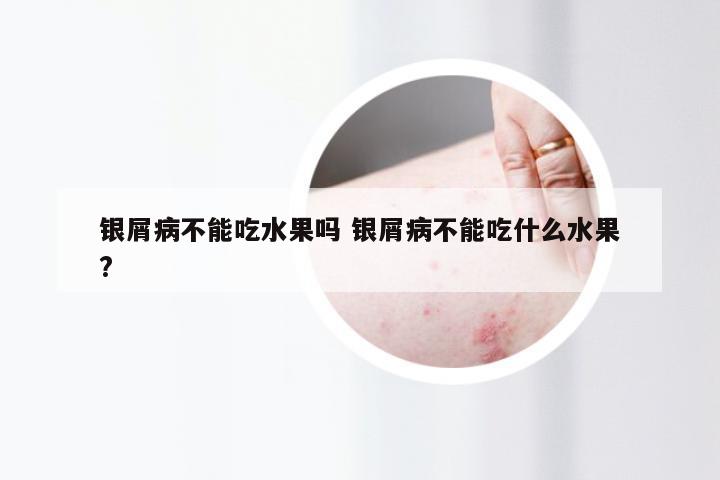 银屑病不能吃水果吗 银屑病不能吃什么水果?