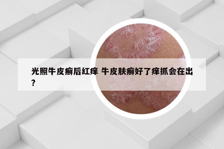 光照牛皮癣后红痒 牛皮肤癣好了痒抓会在出?