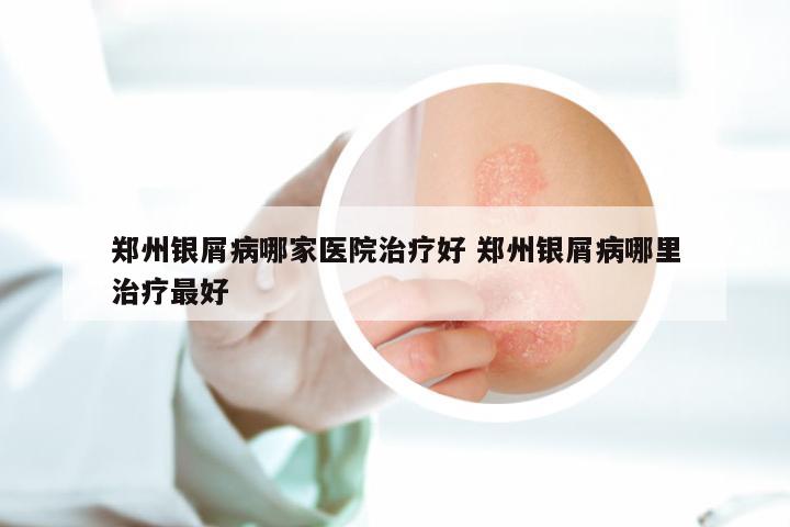 郑州银屑病哪家医院治疗好 郑州银屑病哪里治疗最好