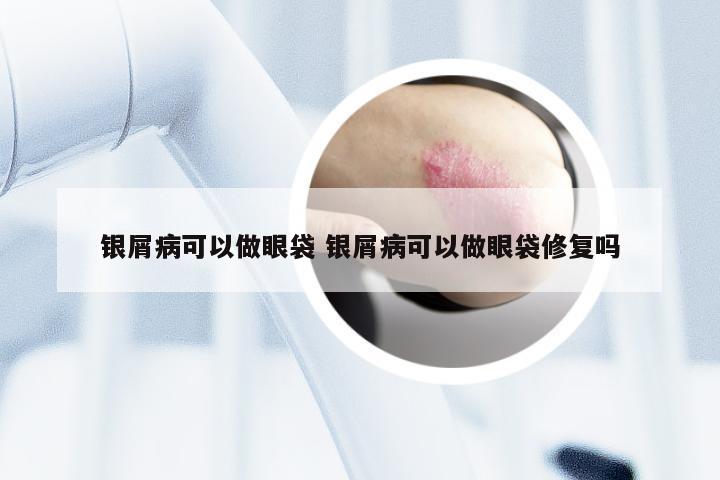 银屑病可以做眼袋 银屑病可以做眼袋修复吗