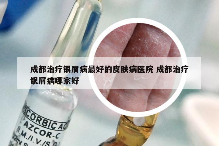 成都治疗银屑病最好的皮肤病医院 成都治疗银屑病哪家好