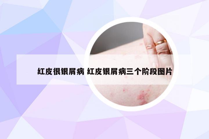 红皮很银屑病 红皮银屑病三个阶段图片
