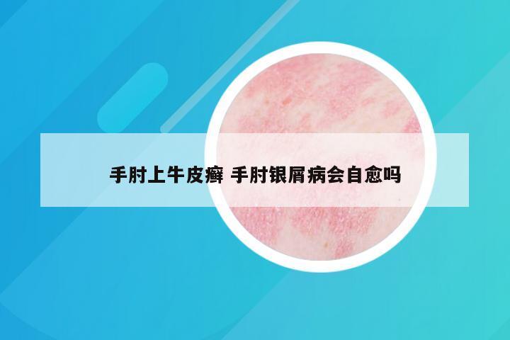 手肘上牛皮癣 手肘银屑病会自愈吗