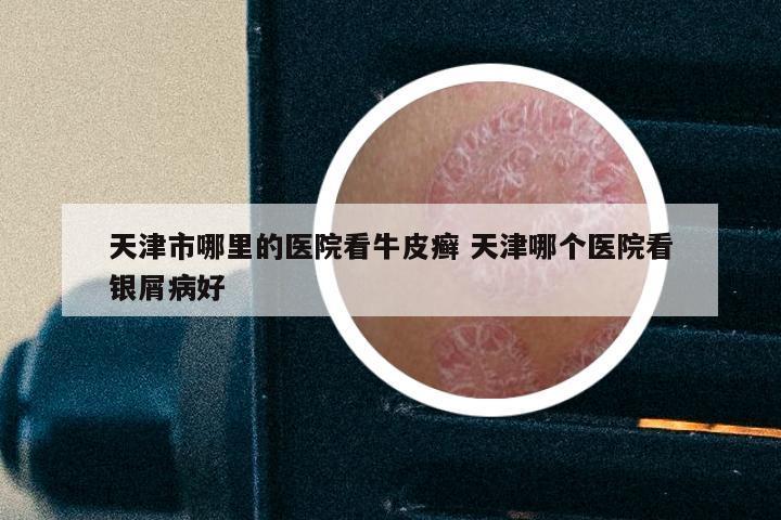 天津市哪里的医院看牛皮癣 天津哪个医院看银屑病好