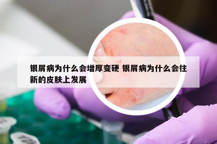 银屑病为什么会增厚变硬 银屑病为什么会往新的皮肤上发展