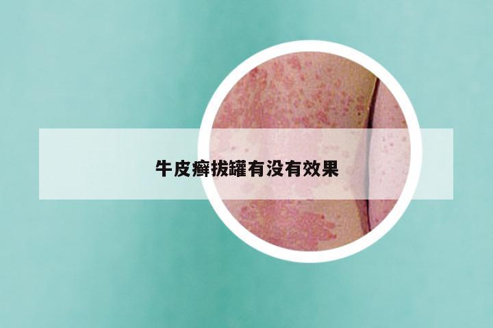 牛皮癣拔罐有没有效果