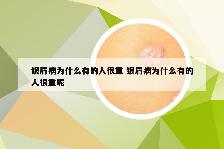 银屑病为什么有的人很重 银屑病为什么有的人很重呢
