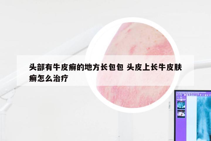 头部有牛皮癣的地方长包包 头皮上长牛皮肤癣怎么治疗