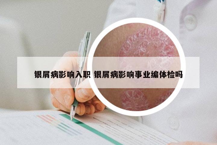 银屑病影响入职 银屑病影响事业编体检吗