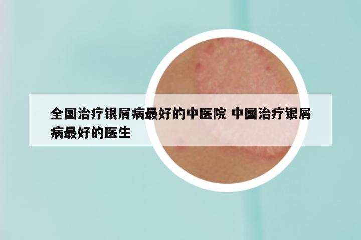 全国治疗银屑病最好的中医院 中国治疗银屑病最好的医生