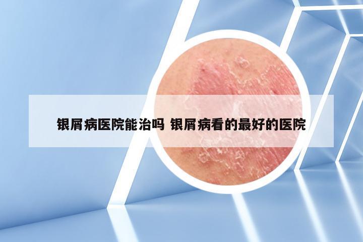 银屑病医院能治吗 银屑病看的最好的医院