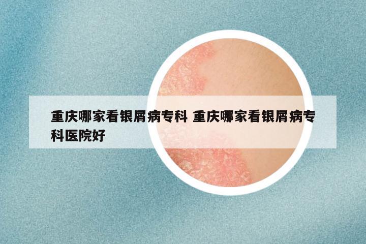 重庆哪家看银屑病专科 重庆哪家看银屑病专科医院好