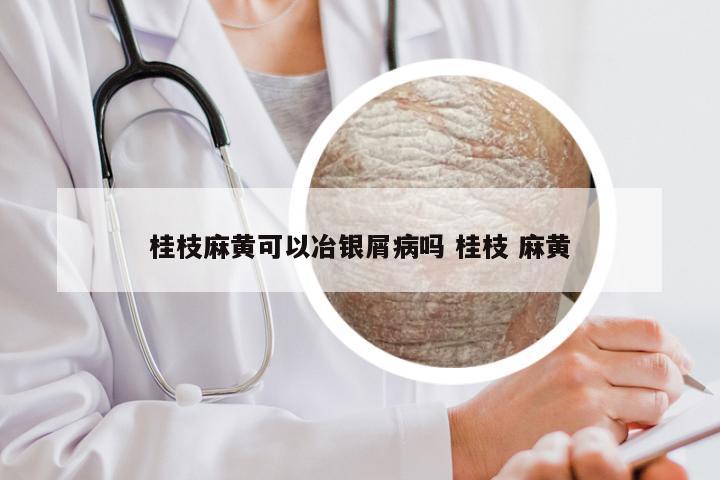 桂枝麻黄可以冶银屑病吗 桂枝 麻黄