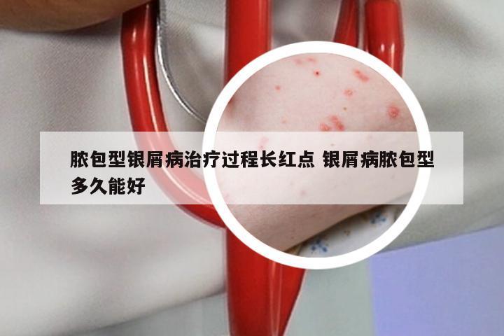 脓包型银屑病治疗过程长红点 银屑病脓包型多久能好