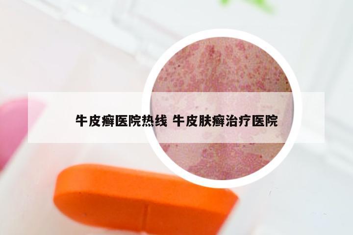 牛皮癣医院热线 牛皮肤癣治疗医院