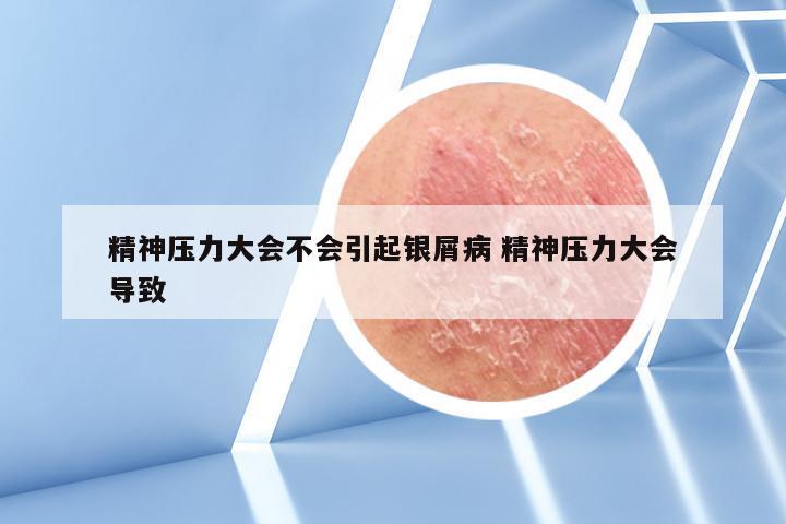 精神压力大会不会引起银屑病 精神压力大会导致