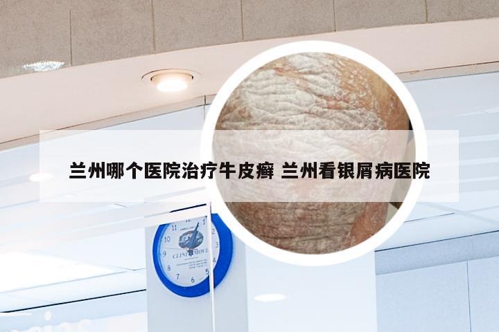 兰州哪个医院治疗牛皮癣 兰州看银屑病医院