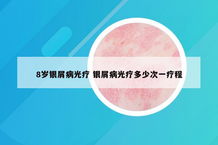 8岁银屑病光疗 银屑病光疗多少次一疗程