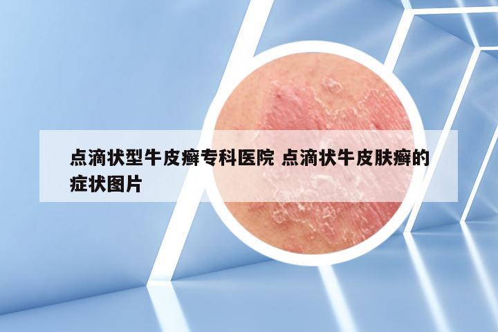 点滴状型牛皮癣专科医院 点滴状牛皮肤癣的症状图片