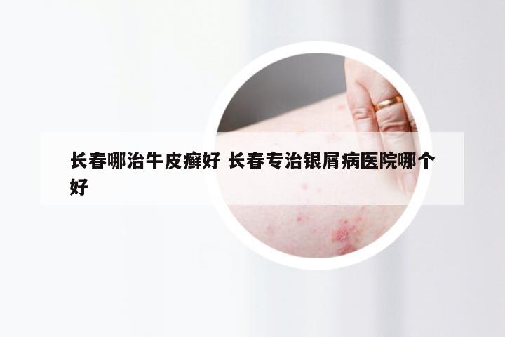 长春哪治牛皮癣好 长春专治银屑病医院哪个好