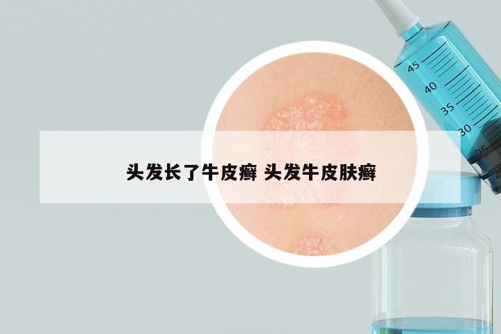 头发长了牛皮癣 头发牛皮肤癣