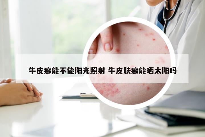 牛皮癣能不能阳光照射 牛皮肤癣能晒太阳吗