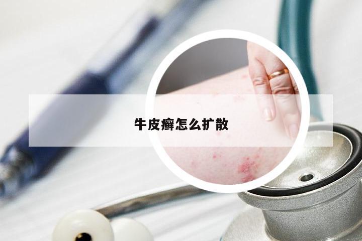 牛皮癣怎么扩散