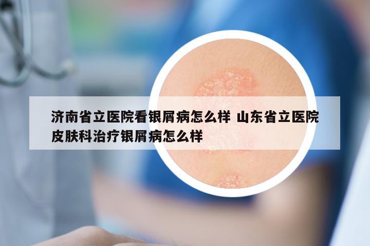 济南省立医院看银屑病怎么样 山东省立医院皮肤科治疗银屑病怎么样